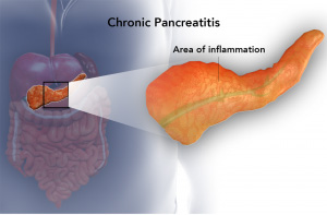 Chronic Pancreatitis