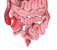 Crohn's Disease