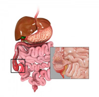 Crohn's Disease