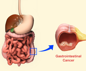 Gastrointestinal Cancer