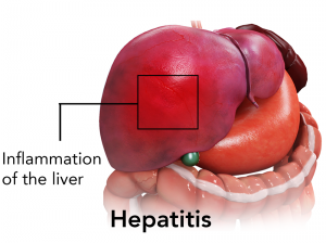 Hepatitis