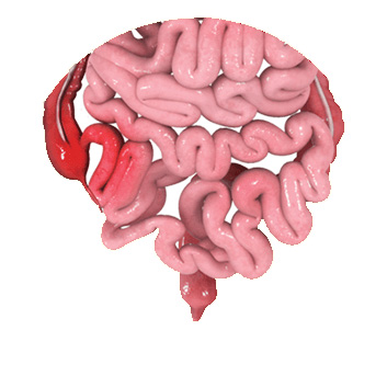 Inflammatory Bowel Disease