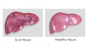 Cirrhosis