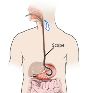 Upper GI Endoscopy