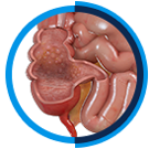 Chronic GI Conditions