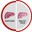 Cirrhosis