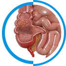 Crohn’s Disease