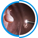 Esophageal Cancer Screening