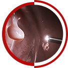 Upper GI Endoscopy