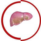 Fatty Liver Disease