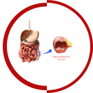 Gastrointestinal Cancer