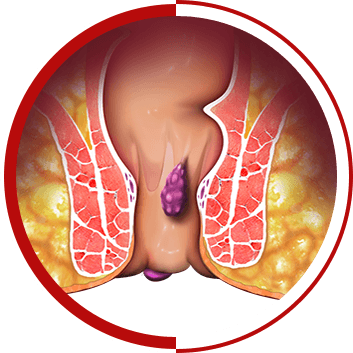 Hemorrhoidal Band Ligation