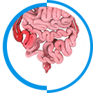 Inflammatory
				Bowel Disease